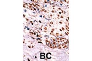 Formalin-fixed and paraffin-embedded human cancer tissue reacted with the primary antibody, which was peroxidase-conjugated to the secondary antibody, followed by AEC staining. (c-MET Antikörper  (pTyr1349))