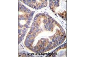 FA Antibody (N-term) (ABIN656101 and ABIN2845443) immunohistochemistry analysis in formalin fixed and paraffin embedded human prostate carcinoma followed by peroxidase conjugation of the secondary antibody and DAB staining.