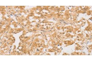 Immunohistochemistry of paraffin-embedded Human thyroid cancer tissue using CD24 Polyclonal Antibody at dilution of 1:40 (CD24 Antikörper)
