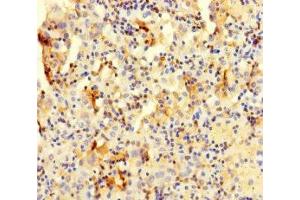 Immunohistochemistry of paraffin-embedded human lung cancer using ABIN7147985 at dilution of 1:100 (COTL1 Antikörper  (AA 2-142))