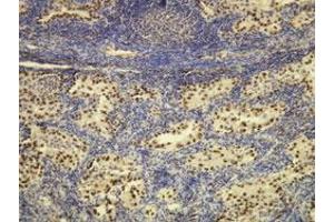 Immunohistochemical staining (Formalin-fixed paraffin-embedded sections) of human lung adenocarcinoma with NKX2-1 monoclonal antibody, clone G21-G . (NKX2-1 Antikörper  (N-Term))