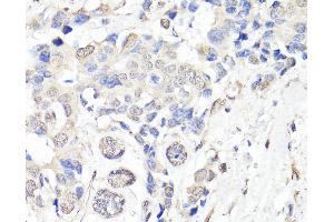 Immunohistochemistry of paraffin-embedded Human breast cancer using BAP1 Polyclonal Antibody at dilution of 1:150 (40x lens). (BAP1 Antikörper)