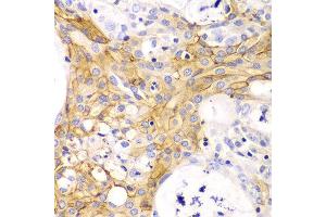 Immunohistochemistry of paraffin-embedded human oophoroma using ACTA2 antibody at dilution of 1:100 (400x lens).