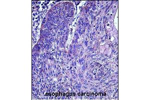 Immunohistochemistry (Paraffin-embedded Sections) (IHC (p)) image for anti-Matrix Metallopeptidase 3 (Stromelysin 1, Progelatinase) (MMP3) (AA 30-59), (N-Term) antibody (ABIN657459)