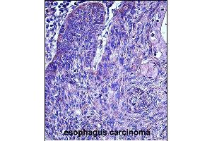 P3 Antibody (N-term)  iunohistochemistry analysis in formalin fixed and paraffin embedded human esophagus carcinoma followed by peroxidase conjugation of the secondary antibody and DAB staining. (MMP3 Antikörper  (N-Term))