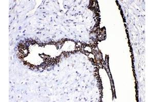 IHC testing of FFPE human breast cancer tissue with CASP8 antibody at 1ug/ml. (Caspase 8 Antikörper  (AA 410-449))