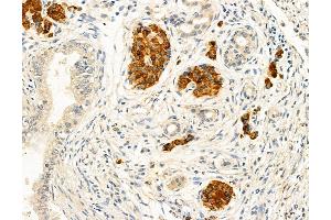 ABIN6263468 and ABIN6272966 at 1/100 staining Human pancreatic cancer by IHC-P. (MYH7 Antikörper  (C-Term))