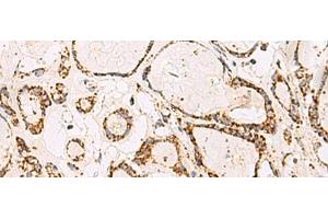 Immunohistochemistry of paraffin-embedded Human thyroid cancer tissue using ATP5O Polyclonal Antibody at dilution of 1:90(x200) (ATP5O Antikörper)