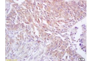 Formalin-fixed and paraffin embedded human lung carcinoma labeled with Rabbit Anti CDC37 Polyclonal Antibody, Unconjugated (ABIN706481) at 1:200 followed by conjugation to the secondary antibody and DAB staining (CDC37 Antikörper  (AA 291-378))