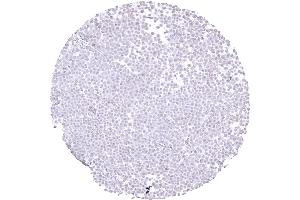 Immunohistochemistry (IHC) image for anti-Cadherin 1, Type 1, E-Cadherin (Epithelial) (CDH1) antibody (ABIN7477465)