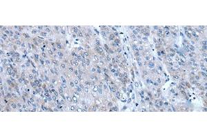 Immunohistochemistry of paraffin-embedded Human liver cancer tissue using ZIC1 Polyclonal Antibody at dilution of 1:65(x200) (ZIC1 Antikörper)