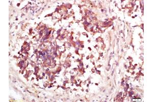 Formalin-fixed and paraffin embedded human lung carcinoma labeled with Anti-Phospho-MDM2(Thr218) Polyclonal Antibody, Unconjugated (ABIN802533) at 1:200 followed by conjugation to the secondary antibody and DAB staining (MDM2 Antikörper  (pThr218))