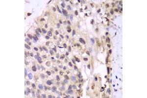 Immunohistochemistry of paraffin-embedded human lung cancer using PSMA6 antibody. (PSMA6 Antikörper)