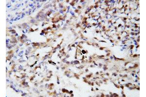 Anti-Ubiquitin antibody, IHC(P) IHC(P): Human Lung Cancer Tissue (Ubiquitin B Antikörper  (N-Term))