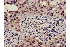 Immunohistochemistry of paraffin-embedded human lung cancer using ABIN7145371 at dilution of 1:100 (B3GALT4 Antikörper  (AA 42-266))