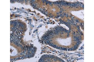 Immunohistochemistry of Human colon cancer using IPO4 Polyclonal Antibody at dilution of 1:50 (Importin 4 Antikörper)