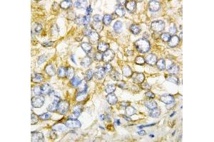 IHC-P: AIMP2 antibody testing of human rectal cancer tissue (AIMP2 Antikörper  (AA 298-320))
