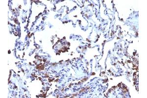 Formalin-fixed, paraffin-embedded human Melanoma metastasized to Lung stained with CD63 Monoclonal Antibody (NKI/C3 + LAMP3/968) (CD63 Antikörper)
