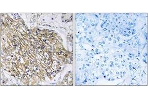 Immunohistochemistry analysis of paraffin-embedded human breast carcinoma tissue, using LPHN2 Antibody. (LPHN2 Antikörper  (AA 551-600))