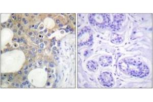 Immunohistochemistry analysis of paraffin-embedded human breast carcinoma tissue, using CD227/MUC1 (Ab-1229) Antibody. (MUC1 Antikörper  (AA 1201-1250))