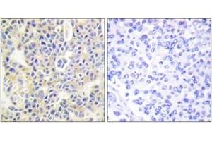 Immunohistochemistry analysis of paraffin-embedded human breast carcinoma, using PKC thet (Phospho-Ser695) Antibody. (PKC theta Antikörper  (pSer695))