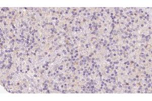 ABIN6273122 at 1/100 staining Human lymph cancer tissue by IHC-P. (HERPUD1 Antikörper  (N-Term))
