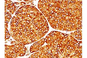 Formalin-fixed, paraffin-embedded melanoma (20X) stained with Tyrosinase Monoclonal Antibody (T311). (TYR Antikörper)