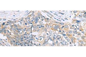 Immunohistochemistry of paraffin-embedded Human esophagus cancer tissue using PPIC Polyclonal Antibody at dilution of 1:50(x200) (PPIC Antikörper)