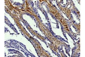 Paraffin embedded human gastric cancer tissue was stained with Goat Anti-Type I Collagen-BIOT, DAB, and hematoxylin. (Collagen Type I Antikörper  (Biotin))