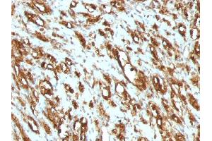 Formalin-fixed, paraffin-embedded human Rhabdomyosarcoma stained with Muscle Specific Actin Mouse Monoclonal Antibody (MSA/953). (ACTA1/ACTA2A/ACTG2 Antikörper)
