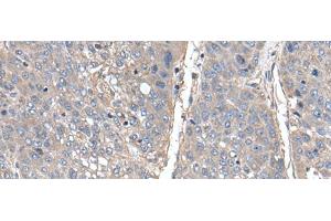 Immunohistochemistry of paraffin-embedded Human liver cancer tissue using THAP10 Polyclonal Antibody at dilution of 1:40(x200) (THAP10 Antikörper)