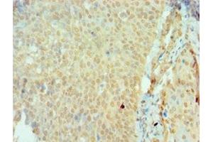 Immunohistochemistry of paraffin-embedded human cervical cancer using ABIN7166161 at dilution of 1:100 (SSX2 Antikörper  (AA 1-188))