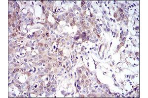 Immunohistochemical analysis of paraffin-embedded esophageal cancer tissues using UBE2C mouse mAb with DAB staining. (UBE2C Antikörper  (AA 1-179))