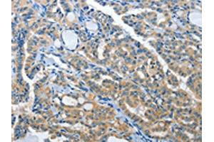 The image on the left is immunohistochemistry of paraffin-embedded Human thyroid cancer tissue using ABIN7192019(PRKX Antibody) at dilution 1/15, on the right is treated with synthetic peptide. (PRKX Antikörper)