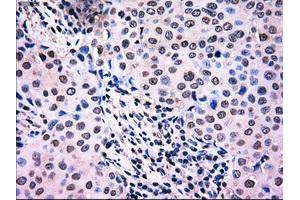 Immunohistochemical staining of paraffin-embedded Adenocarcinoma of breast tissue using anti-NRBP1 mouse monoclonal antibody.