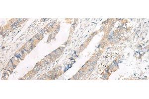 Immunohistochemistry of paraffin-embedded Human colorectal cancer tissue using FERD3L Polyclonal Antibody at dilution of 1:75(x200) (FERD3L Antikörper)