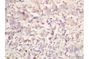 Formalin-fixed and paraffin embedded human lung carcinoma labeled with Rabbit Anti-ATG1/ULK1 Polyclonal Antibody, Unconjugated 1:200 followed by conjugation to the secondary antibody and DAB staining