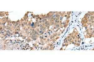 Immunohistochemistry of paraffin-embedded Human lung cancer tissue using SPRY4 Polyclonal Antibody at dilution of 1:25(x200) (SPRY4 Antikörper)