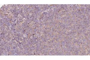 ABIN6273063 at 1/100 staining Human lymph cancer tissue by IHC-P. (P4HA1 Antikörper  (N-Term))