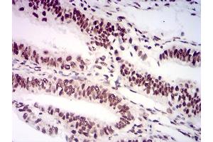 Immunohistochemical analysis of paraffin-embedded endometrial cancer tissues using AKT1S1 mouse mAb with DAB staining. (PRAS40 Antikörper  (AA 92-276))