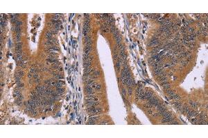 Immunohistochemistry of paraffin-embedded Human colon cancer using CMTM6 Polyclonal Antibody at dilution of 1:30 (CMTM6 Antikörper)