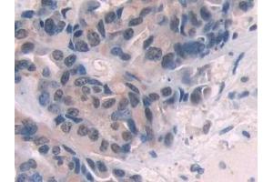 Detection of ENG in Human Breast cancer Tissue using Polyclonal Antibody to Endoglin (ENG) (Endoglin Antikörper  (AA 26-136))