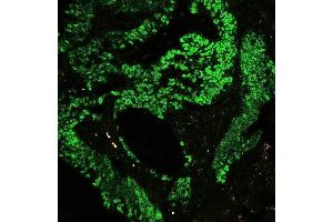 IF analysis of CTBP2 using anti-CTBP2 antibody (ABIN3042768) P-cadherin was detected in paraffin-embedded section of human colon cancer tissues.