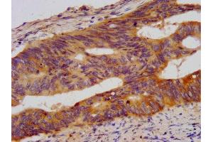 IHC image of ABIN7178015 diluted at 1:500 and staining in paraffin-embedded human colon cancer performed on a Leica BondTM system. (WDR37 Antikörper  (AA 1-496))