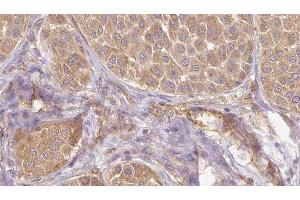 ABIN6273831 at 1/100 staining Human Melanoma tissue by IHC-P. (PAEP Antikörper)