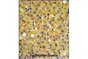 FBP1 Antibody (Center) (ABIN391577 and ABIN2841512) IHC analysis in formalin fixed and paraffin embedded human hepatocarcinoma followed by peroxidase conjugation of the secondary antibody and DAB staining. (FBP1 Antikörper  (AA 125-156))