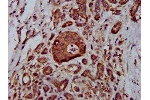IHC image of ABIN7159086 diluted at 1:400 and staining in paraffin-embedded human pancreatic cancer performed on a Leica BondTM system. (MTBP Antikörper  (AA 567-724))