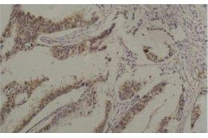 Immunohistochemistry of paraffin-embedded Human breast carcinoma tissue using HSPA8 Monoclonal Antibody at dilution of 1:200. (Hsc70 Antikörper)