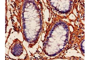 Immunohistochemistry of paraffin-embedded human colon cancer using ABIN7164219 at dilution of 1:100 (PFDN5 Antikörper  (AA 2-154))