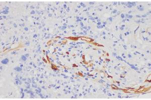 Immunohistochemistry of paraffin-embedded Human lung cancer using S100A7 Polycloanl Antibody at dilution of 1:200 (S100A7 Antikörper)